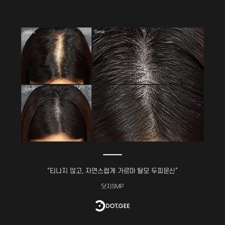  두피문신 일기 2 :: 가르마 탈모엔? 여자 가르마 두피문신