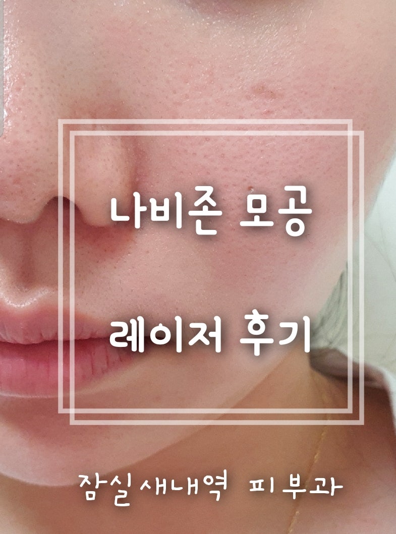 잠실프록셀레이저로 모공고민을