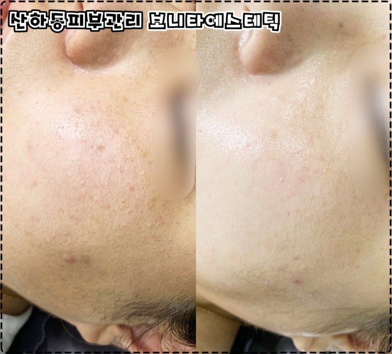 저는 울산 에스테틱에서 피부 관리를 받았습니다
