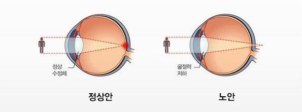  노안.. 해결책은 없을까요??