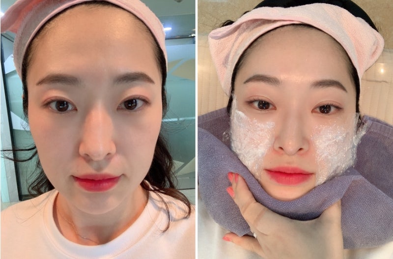 [팔자주름 스컬트라 후기] 튠컬트라