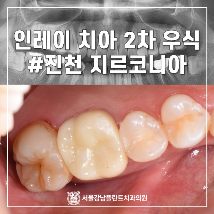  오래된 인레이 치아 통증 (2차 우식) 신경치료와 지르코니아크라운으로
