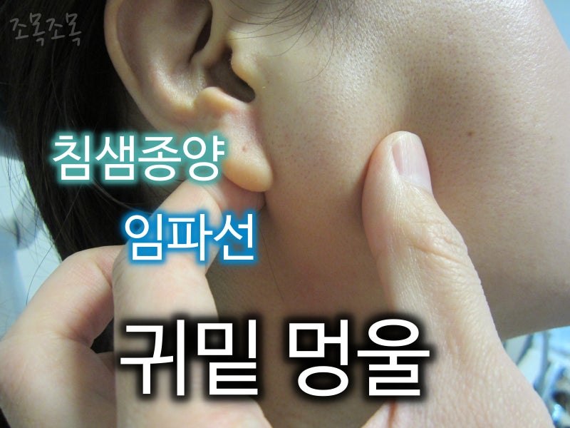 귀밑 목에 혹, 몽우리 - 침샘? 임파선? 특히 병원에서 제대로 확인해야 하는 위치 : 꼼꼼한 초음파, 조직검사 사례 : 네이버 블로그 귀밑 목에 혹, 몽우리 - 침샘? 임파선? 특히 병원에서 제대로 확인해야 하는 위치 : 꼼꼼한 초음파, 조직검사 사례 : 네이버 블로그