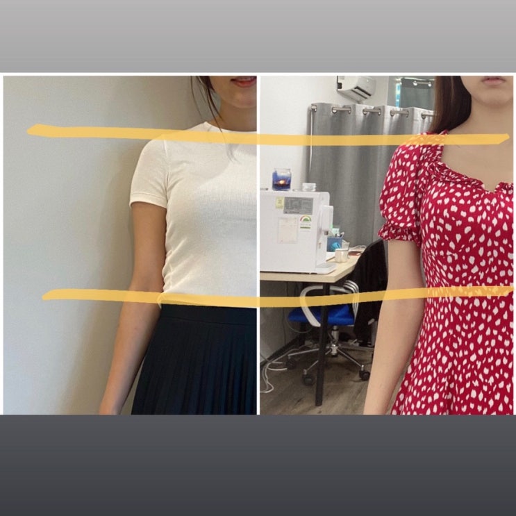  일산 승모근 체형교정이 단기간 될까??