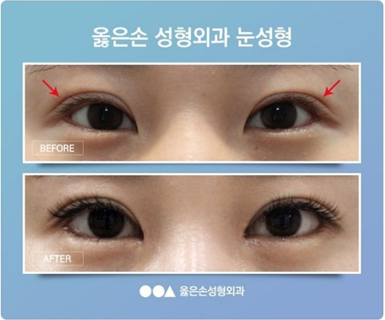  쌍꺼풀재수술비용 어디서 할까