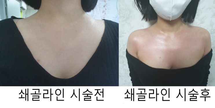  [일산척추교정][일산체형교정][파주척추교정][파주체형교정] 다이어트슬리밍라인마사지 강00님