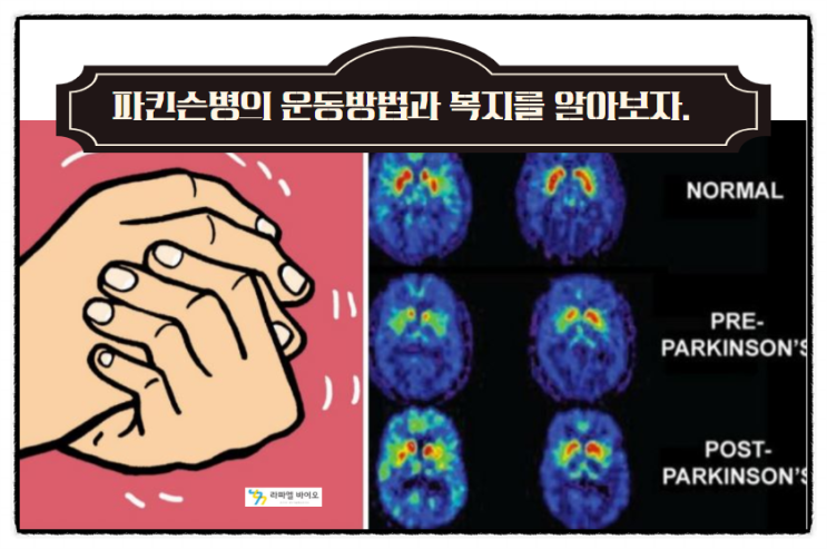  파킨슨병 환자의 운동 기구, 현행 복지와 줄기세포치료 효능에 대하여..