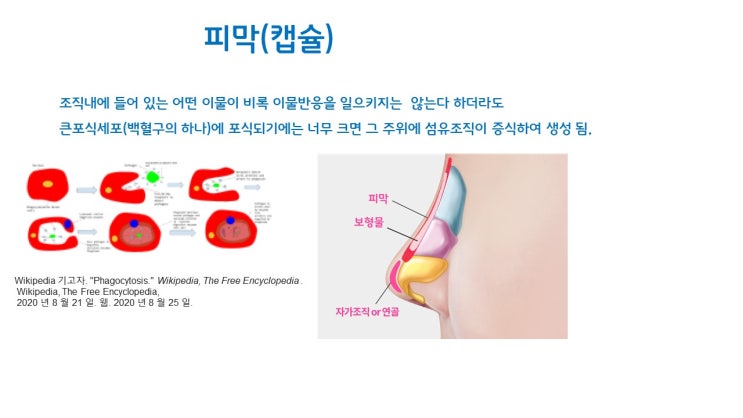  실리콘 보형물 캡슐 코성형후 100% 생깁니다.