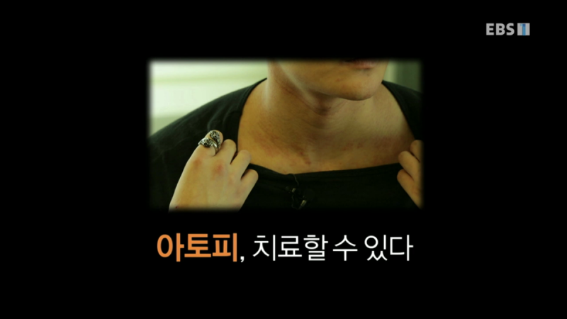 흑아토피 치료법 오일 하나로 깔끔하게! 4