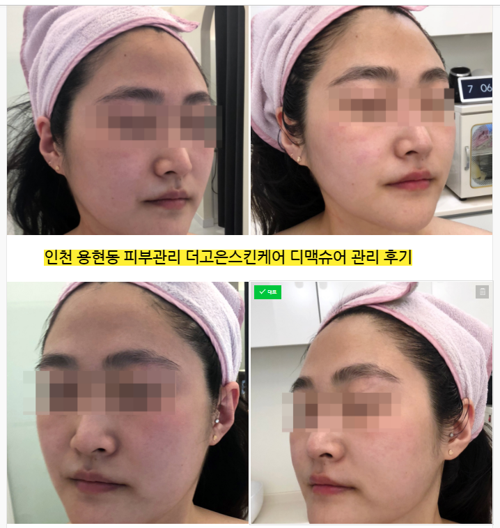  인천 용현동 피부관리 더고은스킨케어 DPL+맥슈어관리 추천