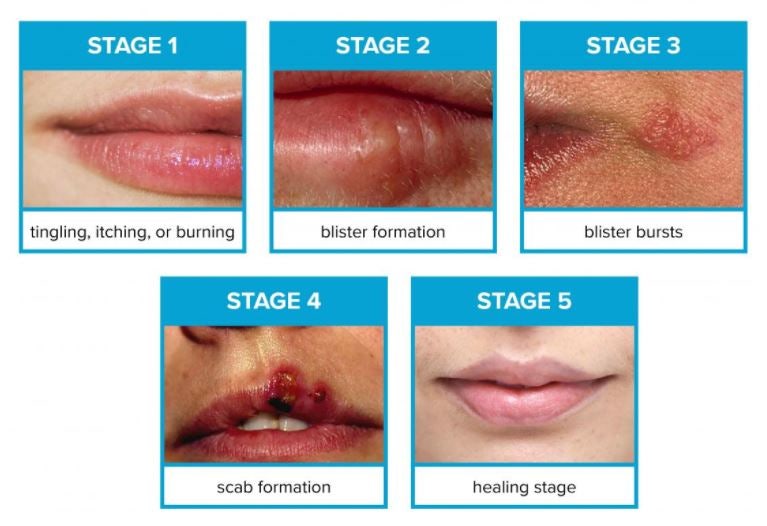 입술 포진 헤르페스 물집 생겼다면 원인은? : 네이버 블로그