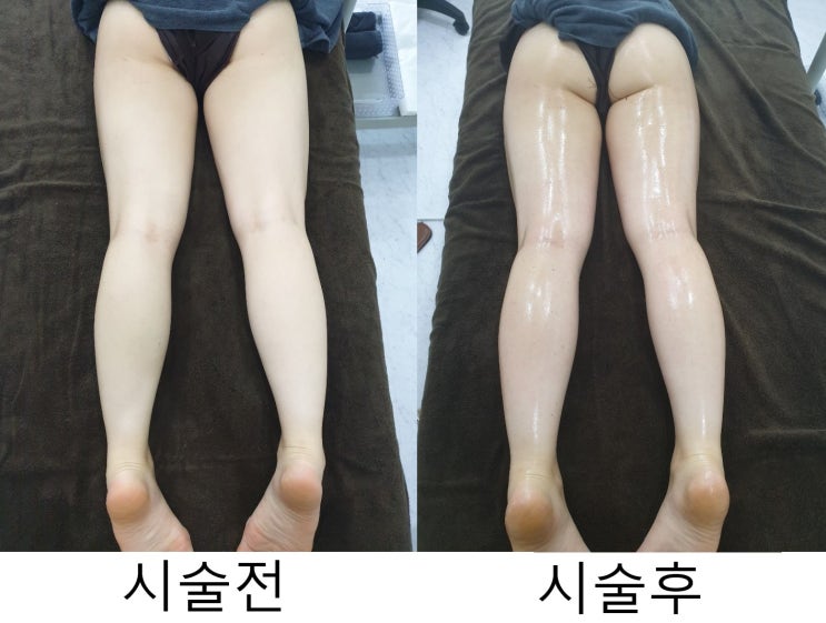  [일산척추교정][일산체형교정][파주척추교정][파주체형교정] 다이어트슬리밍라인마사지 윤00님