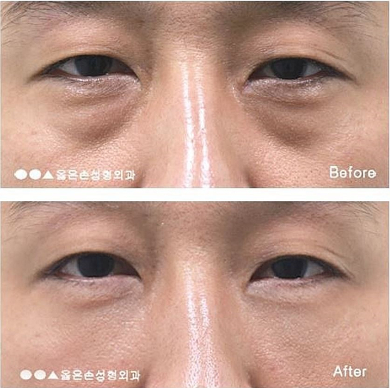  눈밑지방제거수술후기 제대로 받기