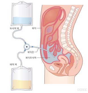  복막투석원리 복막투석장단점 종류유형 : 복막투석과정 합병증 간호중재 환자교육