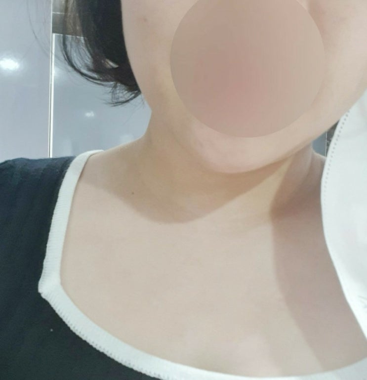  윤곽 주사 후기 1회차 볼살 투턱 없애기 +6일 경과 효과 대박