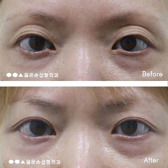  눈재수술잘하는곳 신중하게 결정