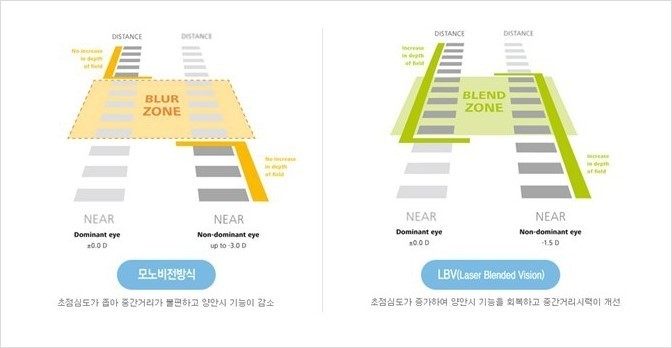  노안라식은 좋을까? 좋지 않을까?