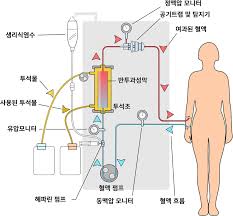 혈액투석원리 혈액투석장단점 과정 : 동정맥 혈액투석합병증 간호중재 수술교육