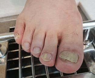 주안 발톱무좀 전문적으로 관리해주는 페디아이티엔 방문