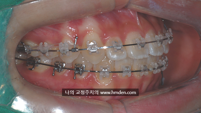 주의사항 3. 교정장치 부착 후 주의사항 / 미사교정치과 / 연세꿈꾸는아이치과