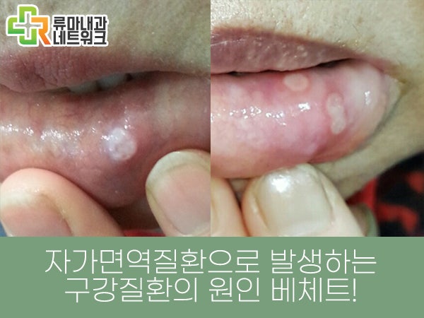 베체트병 증상 치료 병원 선택이 치료의 시작