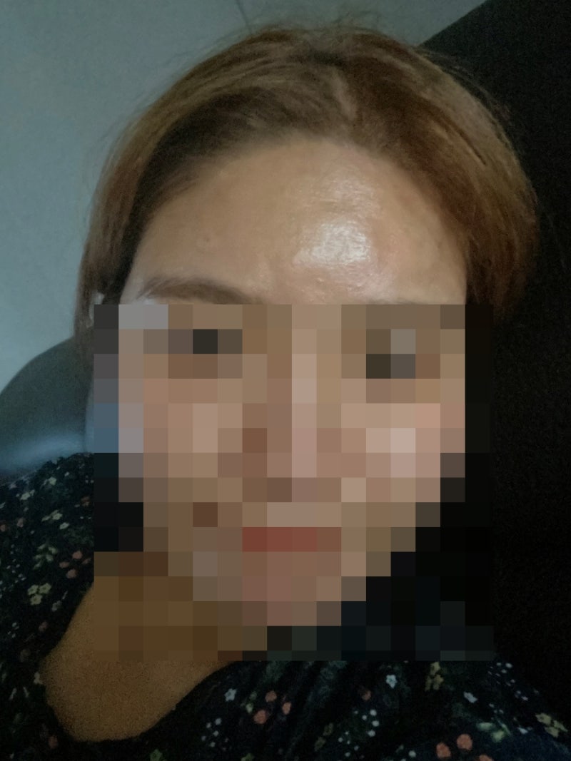 [이마필러 후기] 4Cc 내 돈주고 맞은 후기(9일간의 경과기록, 가격공개) : 네이버 블로그