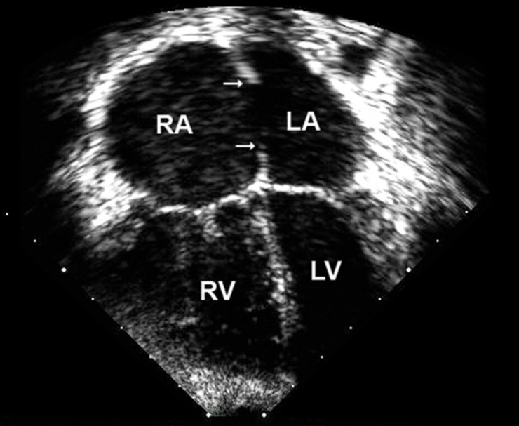  심방중격결손 (ASD : Atrial Septal Defect)