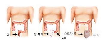  장루환자 장루종류 관리방법준비물 : 장루교환방법 간호중재교육
