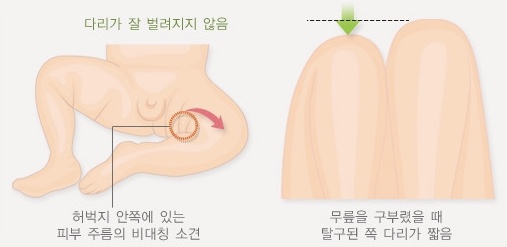  발달성 고관절 탈구란? (Developmental Dislocation of Hip : DDH)