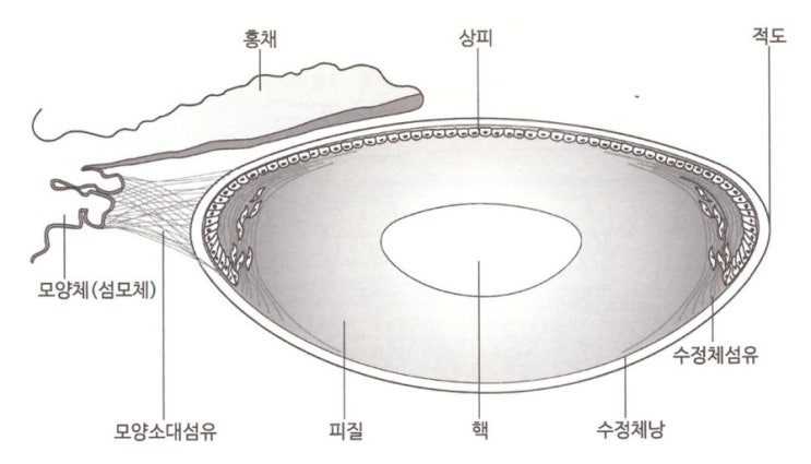 다초점백내장과 단초점백내장의 정확한 차이!!!!!!!