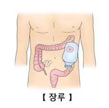  장루교환방법 주머니부착판교체 장루관리교육 : 장루환자간호 합병증