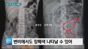  장폐색증상징후 치료방법진단법 장폐색합병증 : 장질환수술 간호진단케이스
