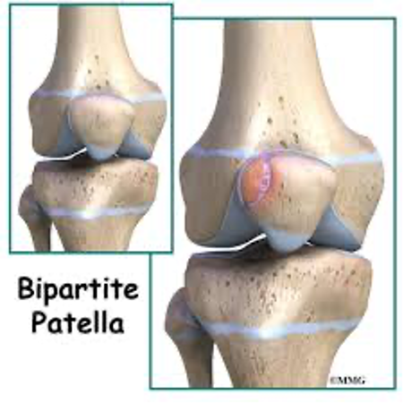 Bipartite patella (이분 슬개골) : 네이버 블로그