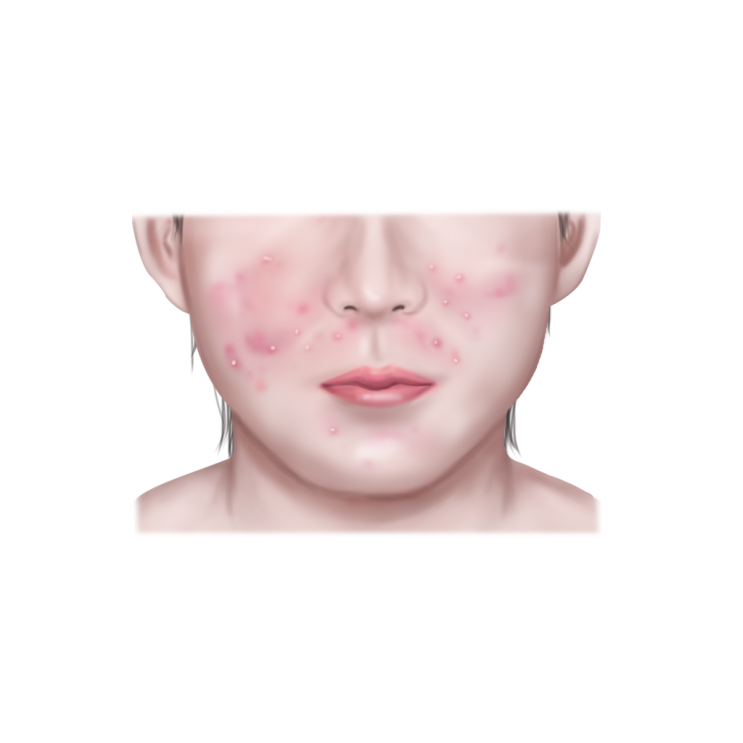  아토피 피부염 관리하는 법 제대로 알기