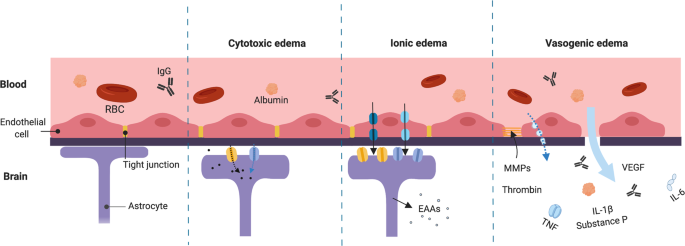  다리부종원인, 알부민, Albumin edema