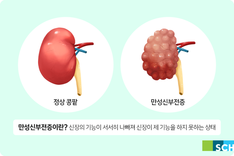 신부전증(급성/만성/말기) 증상 및 원인 치료법
