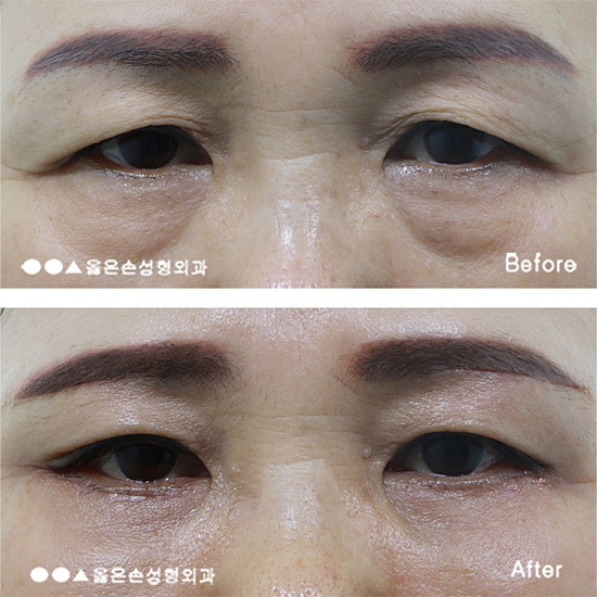  눈밑주름제거수술잘하는곳 여기서 했어요
