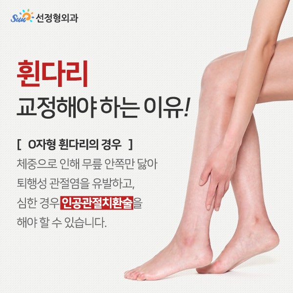 오다리교정수술 O자형 휜 다리에 4