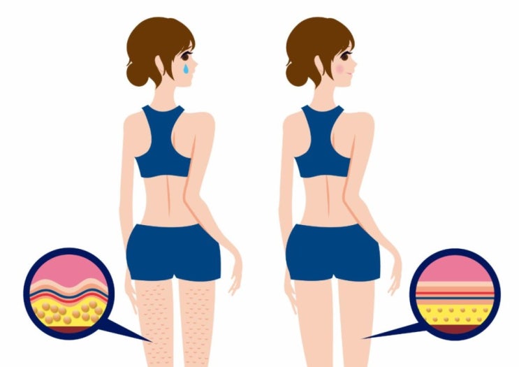  바디 슬리밍 크림 효과 있을까? 셀룰라이트 없애는 법