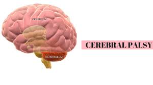  뇌성마비(Cerebral palsy)에 대해서 알아보겠습니다.