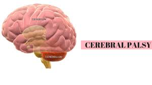 뇌성마비(Cerebral palsy)에 대해서 알아보겠습니다.