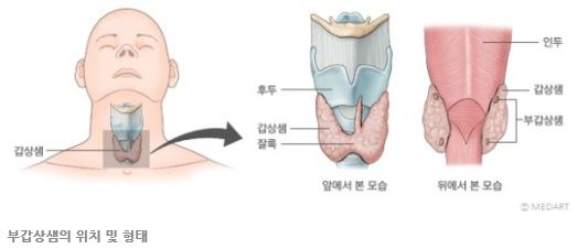  고칼슘혈증_예상4가지