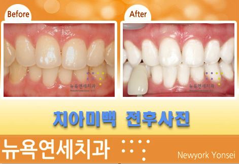 치과에서 치아미백을 효과가 사람마다 다른 이유가 있나요?