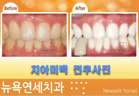  치과에서 치아미백을 효과가 사람마다 다른 이유가 있나요?