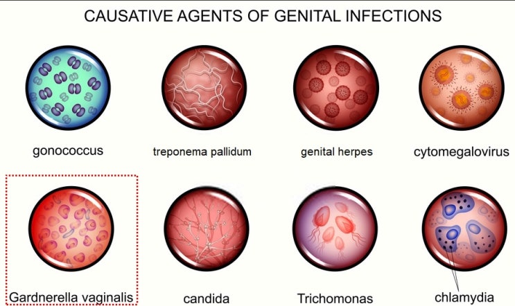  가드넬라 질염 'Gardnerella vaginalis 원인과 치료'