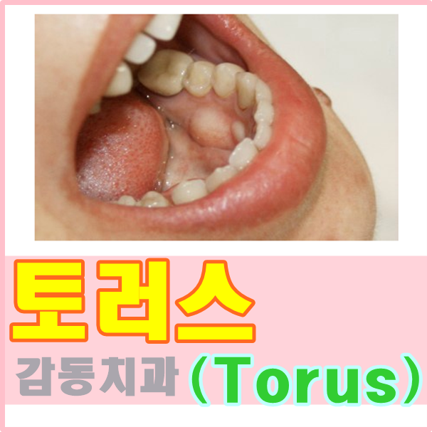  당감동치과, 입안에 혹이 생겼어요 /골융기(토러스)
