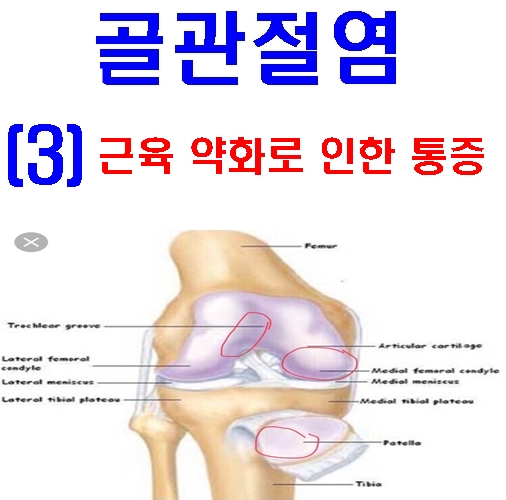  무릎연골연화증 운동 : 대구 중구 체형교정 재활 PT
