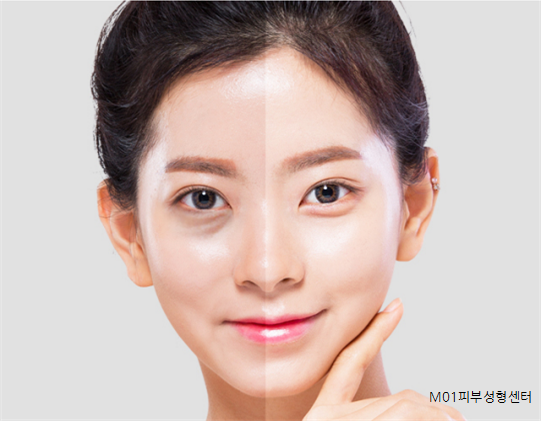  인천 부평 눈밑지방재배치로 생기있게!