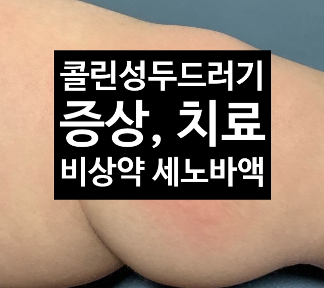  콜린성 두드러기란? 증상 , 치료, 비상약 세노바액