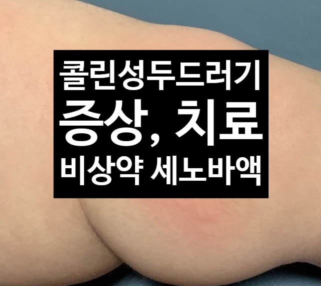 콜린성 두드러기란? 증상 , 치료, 비상약 세노바액